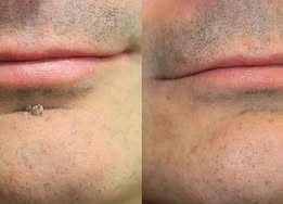 ✨Diufar®2-in-1 Microneedle & Hydrocolloid Patch🍀| Removes Raised Moles, Acne, Flat Warts & Skin Tags | Helps Improve Wrinkles, Scars & Blemishes | Invisible Patches for Face & Body