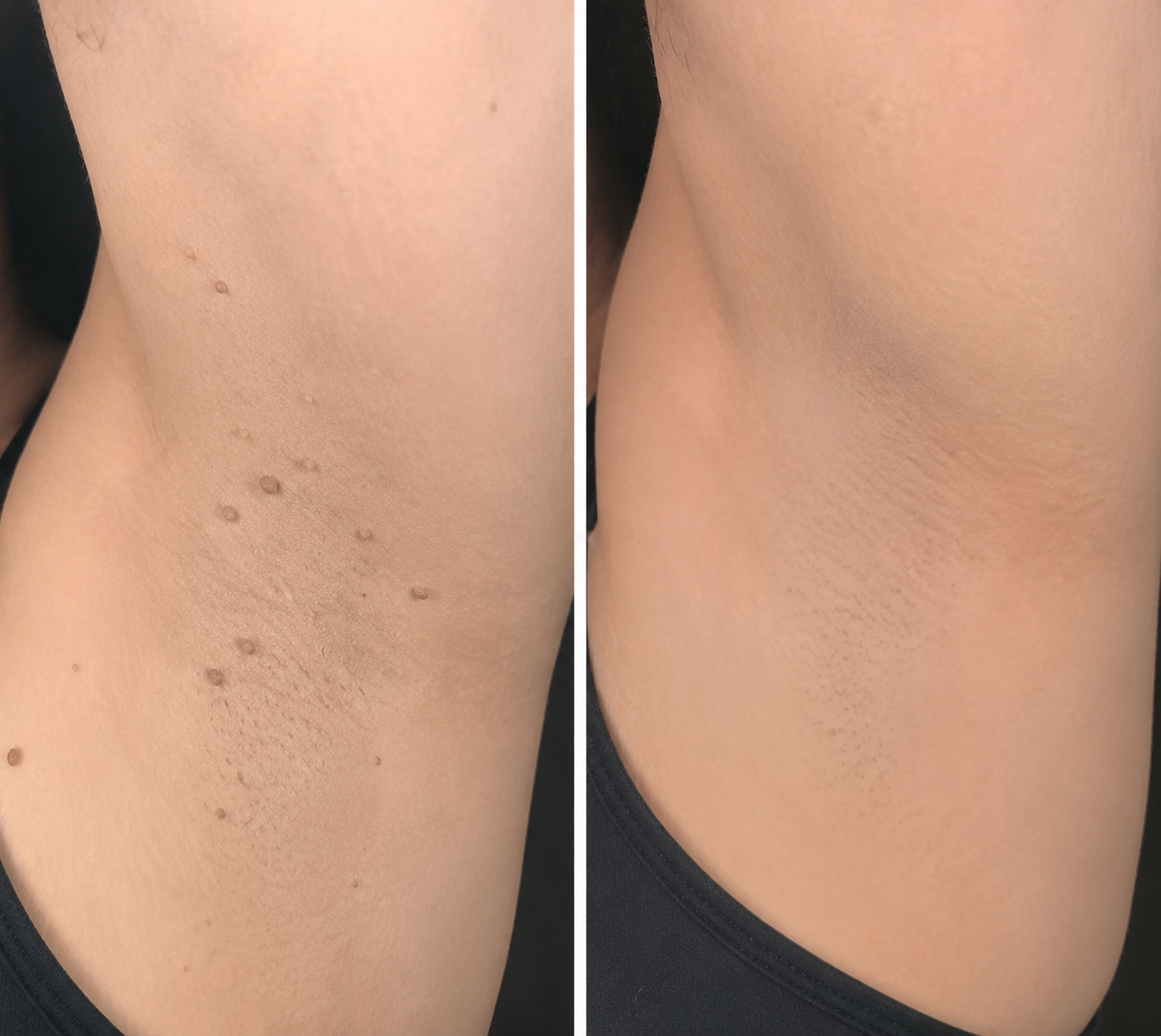 ✨Diufar®2-in-1 Microneedle & Hydrocolloid Patch🍀| Removes Raised Moles, Acne, Flat Warts & Skin Tags | Helps Improve Wrinkles, Scars & Blemishes | Invisible Patches for Face & Body