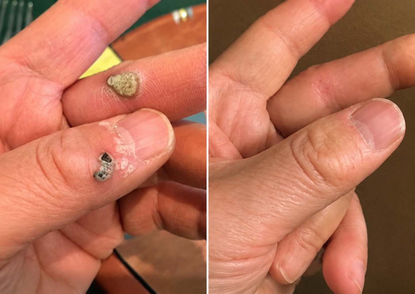 ✨Diufar®2-in-1 Microneedle & Hydrocolloid Patch🍀| Removes Raised Moles, Acne, Flat Warts & Skin Tags | Helps Improve Wrinkles, Scars & Blemishes | Invisible Patches for Face & Body
